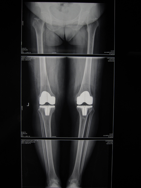 膝关节表面置换术