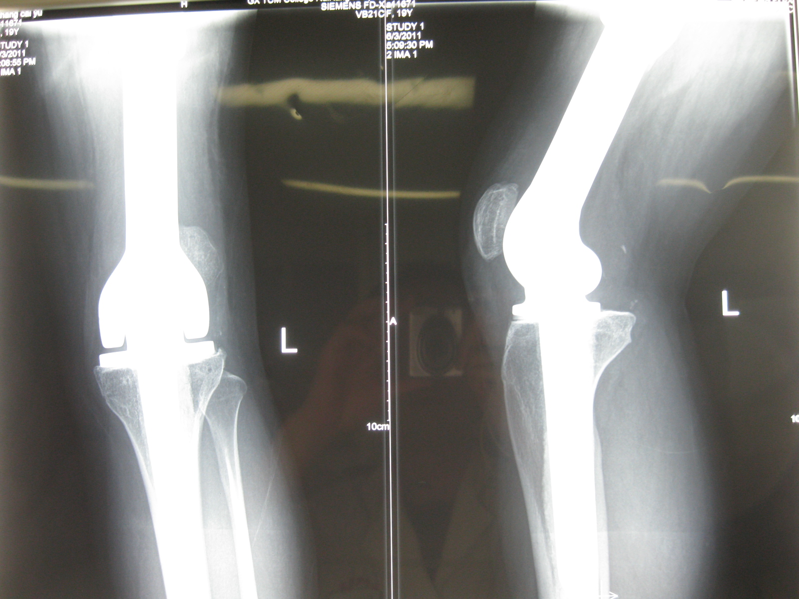 铰链式人工膝关节保肢治疗股骨远端骨肉瘤