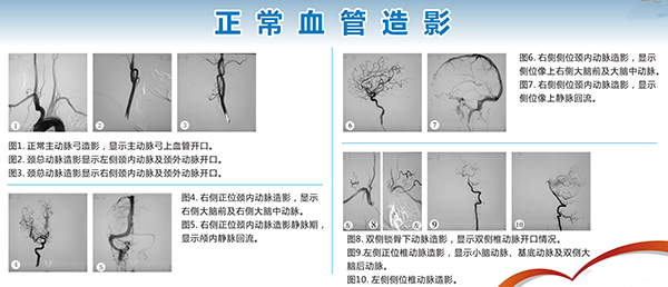 全脑血管造影简介