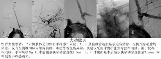 神经介入治疗介绍