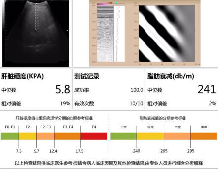 我院肝病科引进 FibroTouch系统