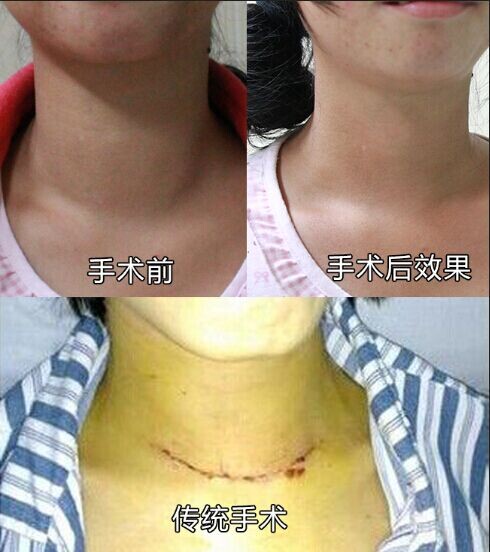 年轻妈妈患上“大脖子病” 微创手术去甲亢隐疤痕