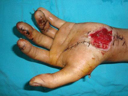 四肢创伤皮肤缺损修复技术―皮瓣