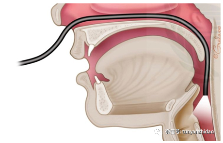 纤维内窥镜吞咽功能检查在临床中的应用