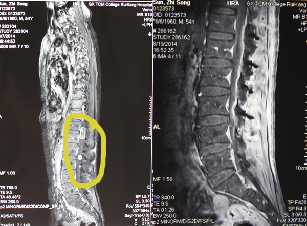 治不好的腰腿痛 考虑椎管内肿瘤――神经外科成功完成一例罕见椎管内多发神经鞘瘤