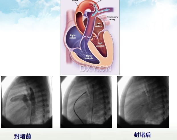 先天性心脏病动脉导管未闭（PDA）介入治疗