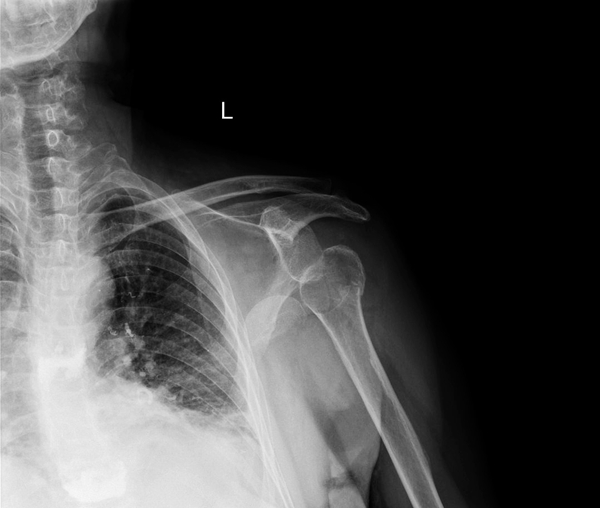 骨四肢二区成功开展肱骨近端粉碎性骨折人工肩关节置换术