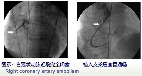冠心病的介入治疗