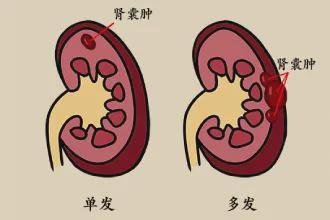 体检报告惊现“肾囊肿”？！别慌，医生教你如何应对