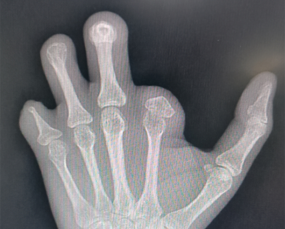 无中生有，移花接木丨瑞康医院显微外科技术让失去的手指再“长”出来