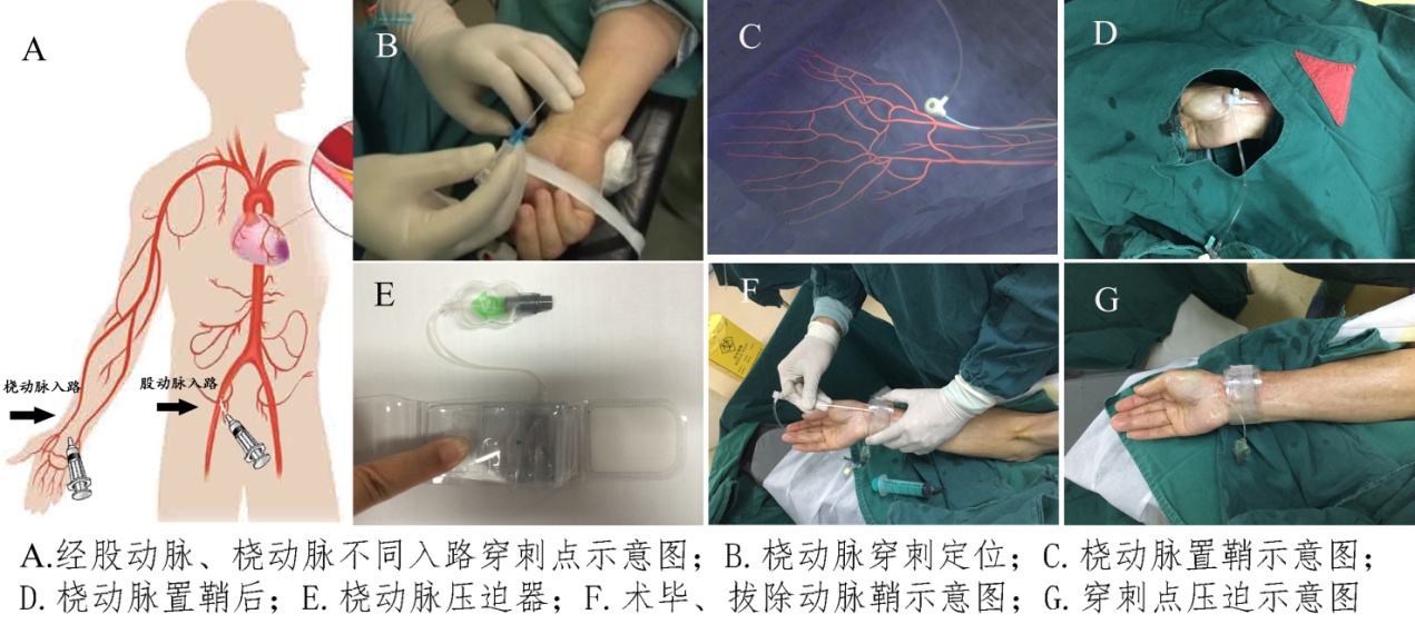 全脑血管造影的新宠儿——经桡动脉优势介绍