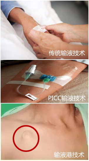 输液港——肿瘤患者的春天